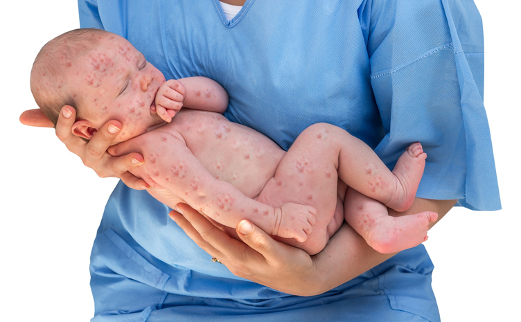 un niño con siembra de piel en las manos de un médico