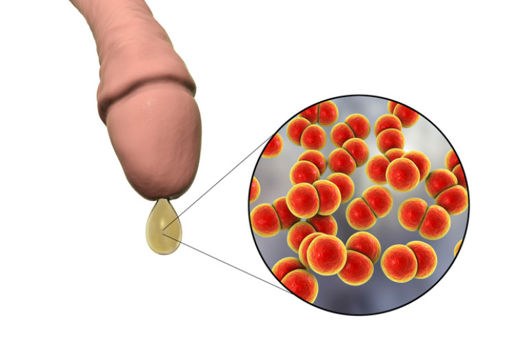 Acema del pene con secreción y bacterias microscópicas de la gonorrea.