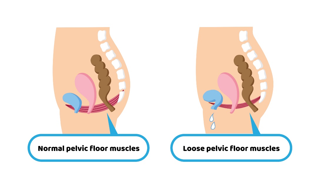 Estado fisiológico de la musculatura del suelo pélvico y estado permisivo de la musculatura del suelo pélvico que provoca incontinencia