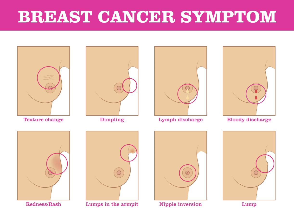 Síntomas del cáncer de mama: cambio en la estructura de la mama, cambio en el color y la superficie de la mama, secreción y retracción del pezón, localización del bulto.