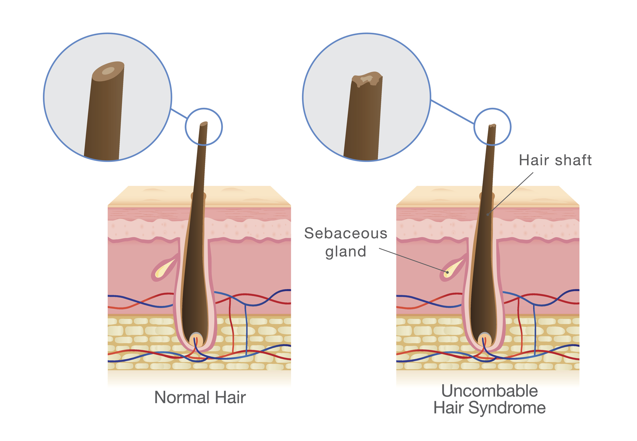 Comparación: cabello normal a la derecha y cabello con síndrome del cabello ingobernable a la izquierda.