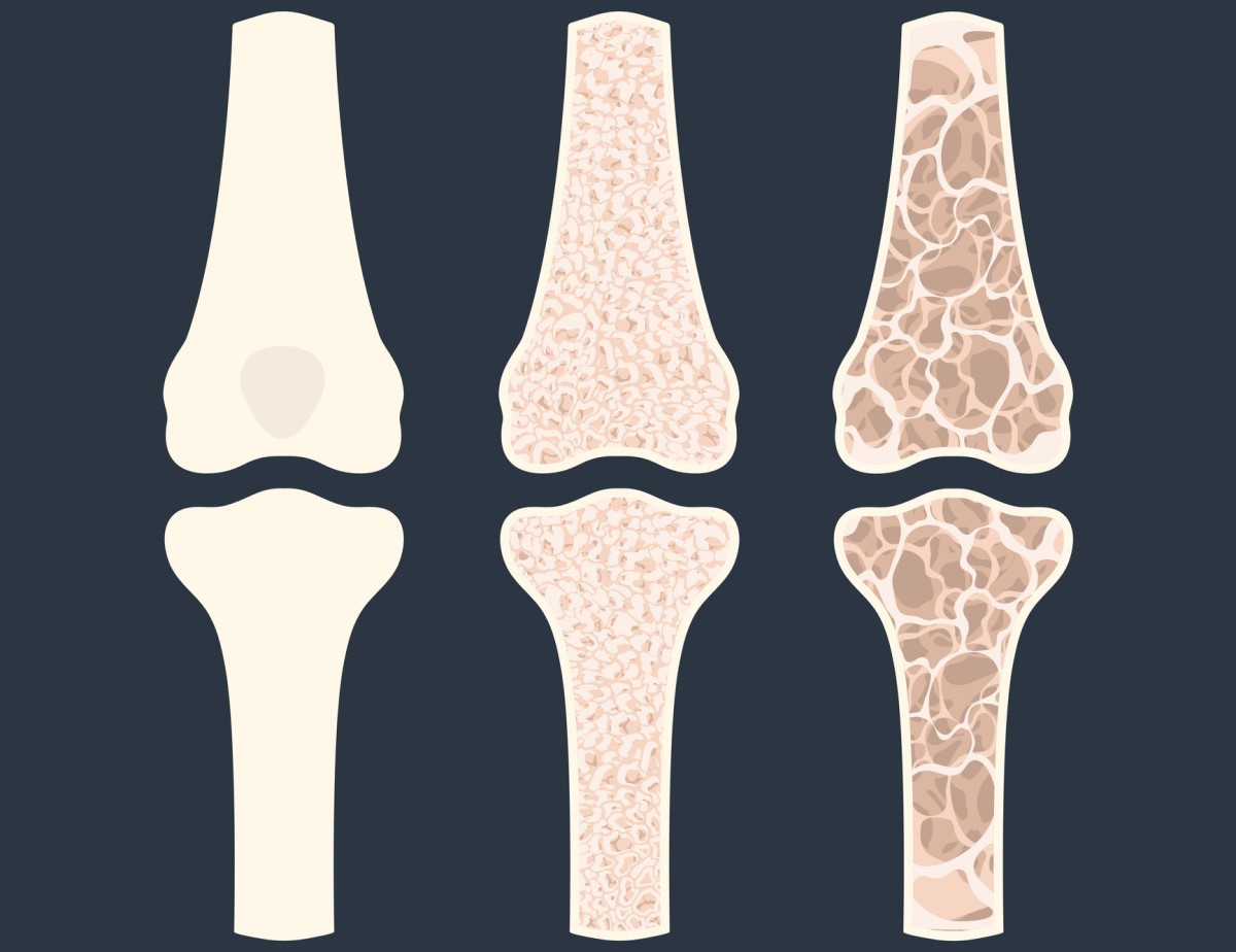 Animación de tres huesos que muestran osteoporosis - adelgazamiento de los huesos