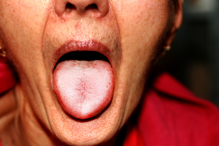 una mujer con camiseta roja saca la lengua afectada por el moho