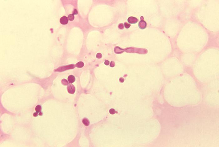 micosis causante de la pitiriasis versicolor