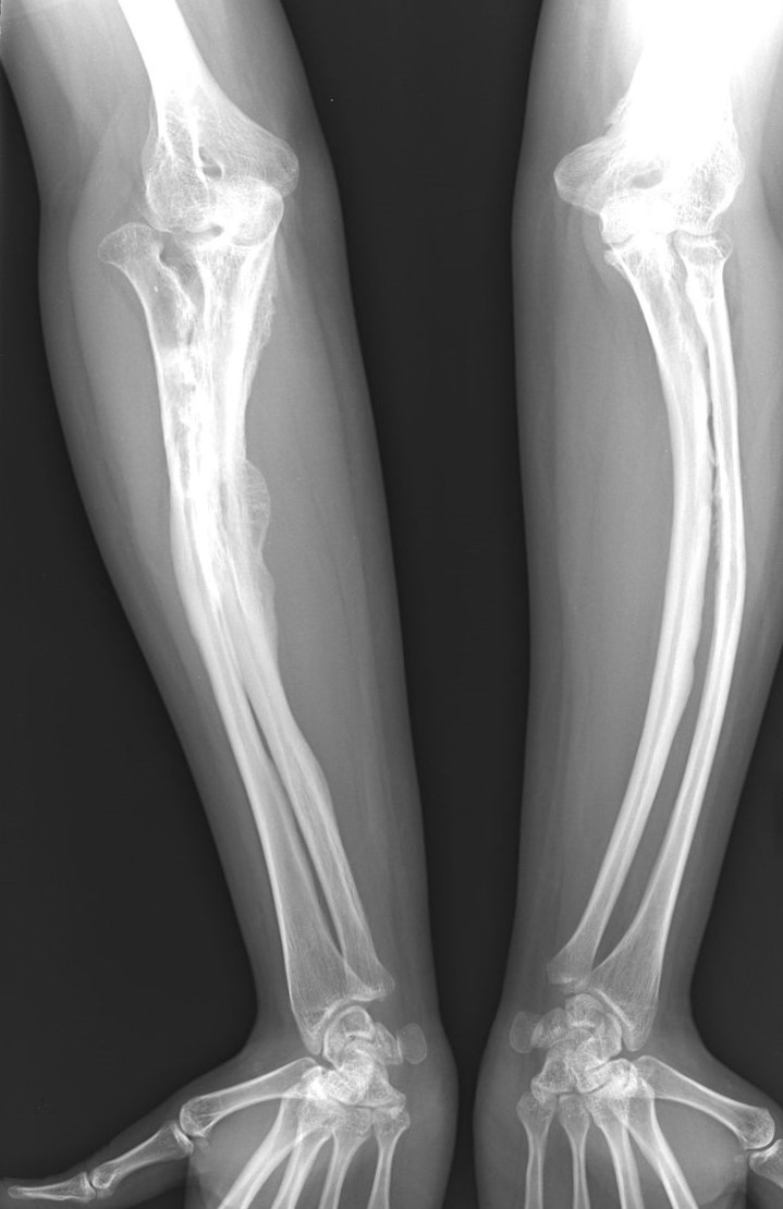 Radiografías de la enfermedad de osteogénesis imperfecta en un adulto