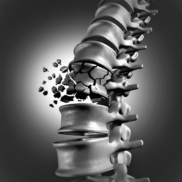 Fractura vertebral de la columna vertebral