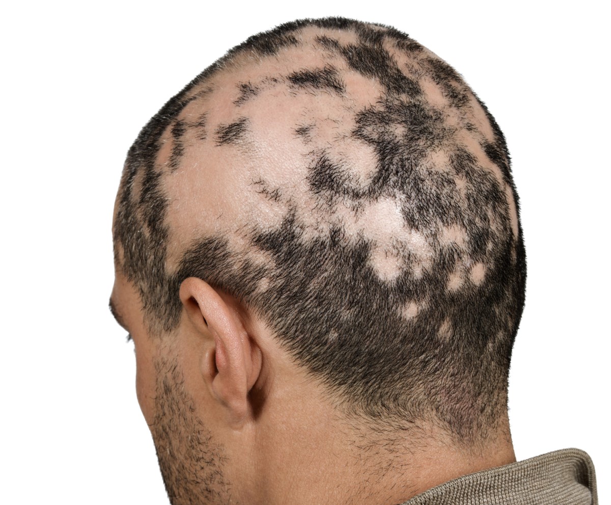 Cabeza masculina - caída del cabello - caída excesiva del cabello en forma de islotes - alopecia areata