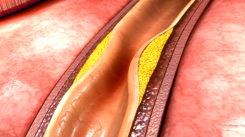 aterosclerosis, depósito de grasa en la pared vascular