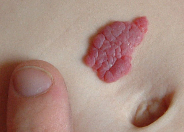 nevus vascular en el abdomen cerca del ombligo como marca de nacimiento de los vasos sanguíneos