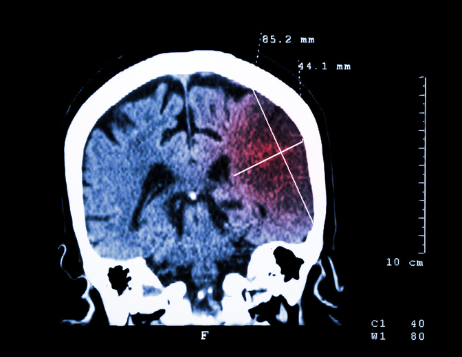 Daño cerebral visible en la TC