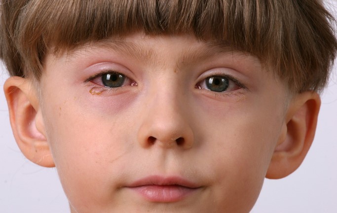 El niño tiene inflamación de los ojos, conjuntivitis, es decir, inflamación de la conjuntiva.