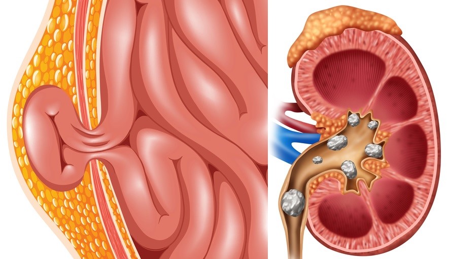 Hernia, cálculos renales y urinarios