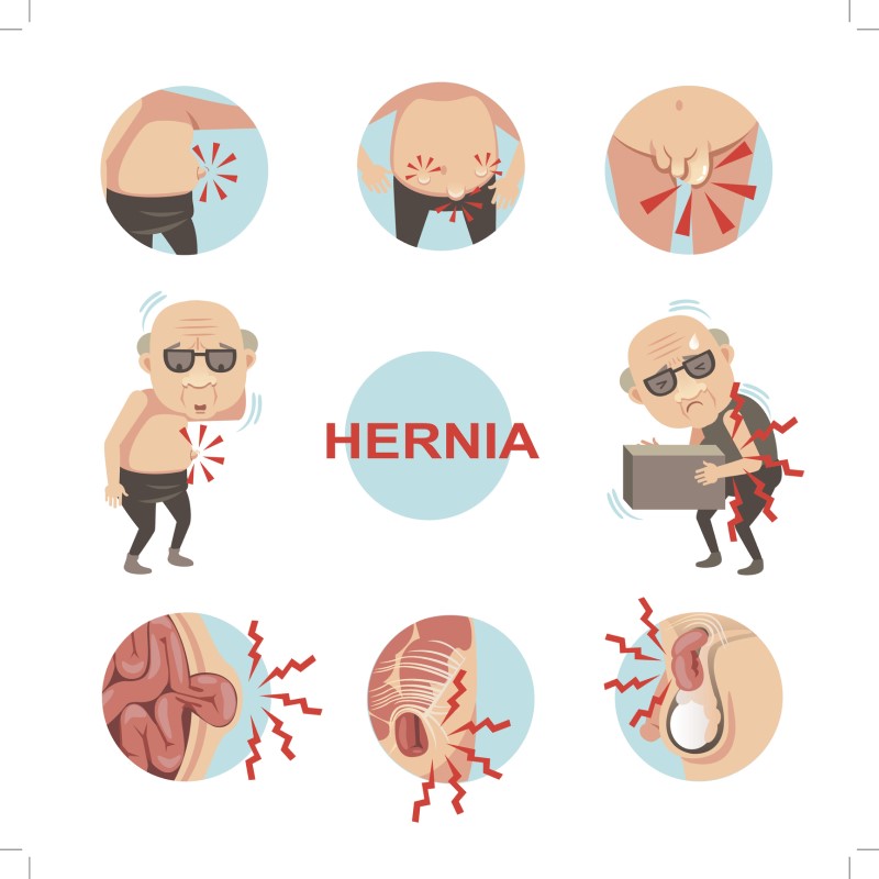 Hernia - modelo de síntomas