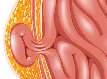 Hernia, la complicación más frecuente de la ascitis