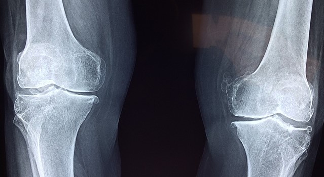 Radiografía de las articulaciones de la rodilla