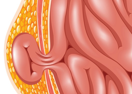 Modelo de hernia, es decir, hernia de la pared abdominal