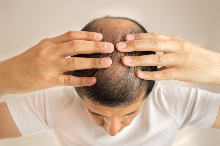 Hombre con cabello escaso, pérdida de cabello, calvicie o alopecia, manos en la cabeza, vista superior