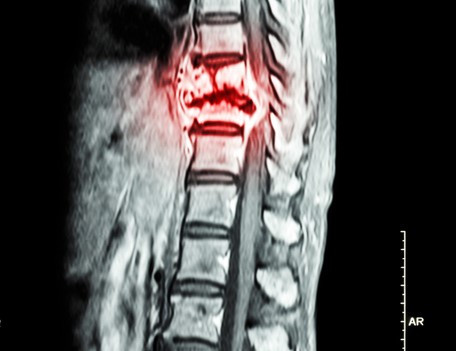 Radiografía de la columna torácica con evidencia de cáncer en la columna torácica.