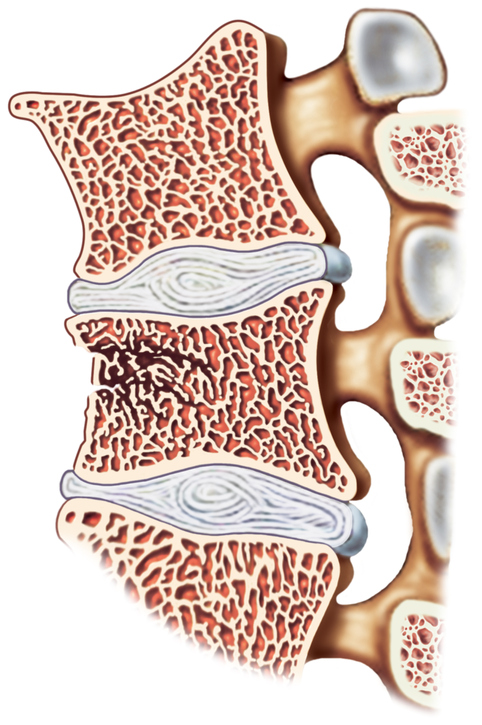 columna vertebral, representación de vértebras y discos intervertebrales, fractura vertebral