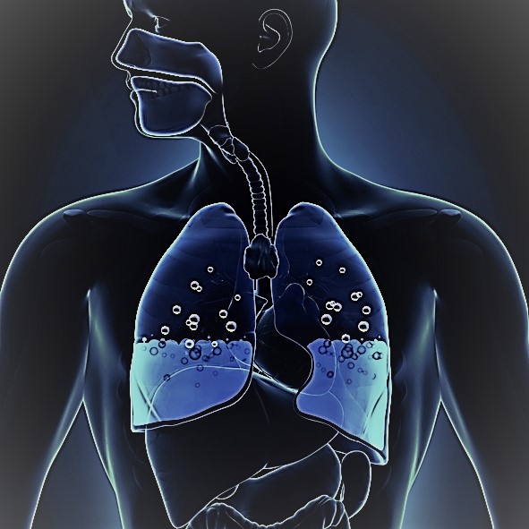 Representación esquemática de los pulmones con hinchazón, agua en el centro de los pulmones, vías respiratorias