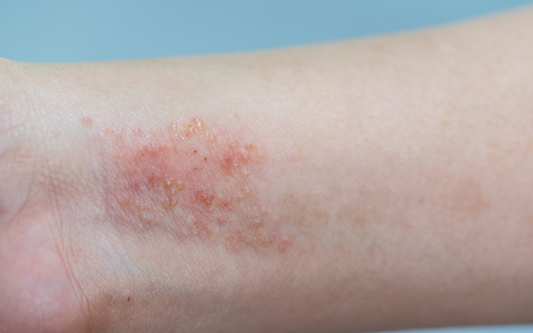 Eczema en muñecas y antebrazos, inflamación de la piel hinchada y enrojecida como la dermatitis de contacto.