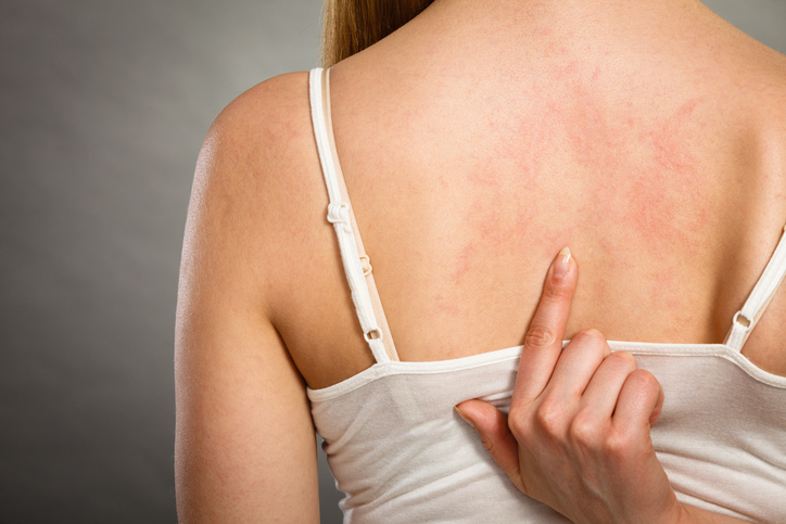 La mujer tiene urticaria en la espalda, así que la señala con el dedo.