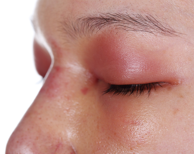 los ojos de la mujer están inflamados, rojos e hinchados