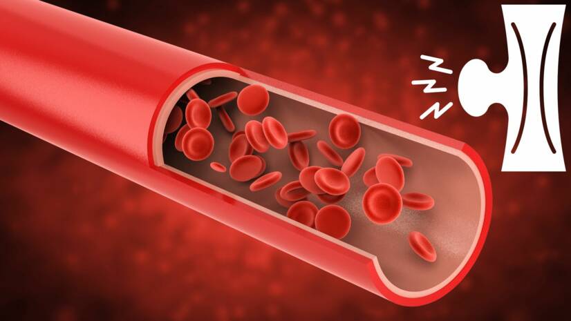 Aneurisma: ¿Qué es un aneurisma vascular, cómo se manifiesta y cuáles son sus riesgos?