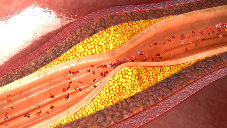 Aterosclerosis: ¿conoce los síntomas o las causas, los riesgos, la prevención?