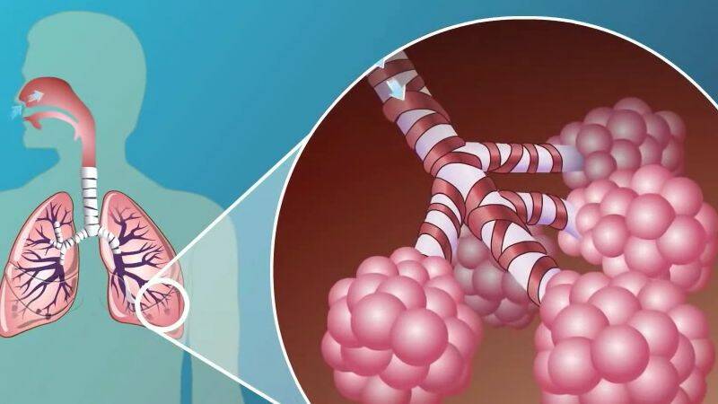 Enfermedad pulmonar obstructiva crónica: ¿por qué se produce y quién está en riesgo?