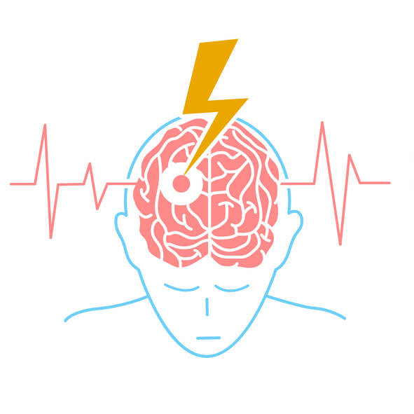 ¿Qué es un ictus? ¿Conoce sus síntomas, riesgos y tratamiento?