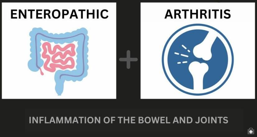 Artritis enteropática y enfermedad inflamatoria intestinal: cómo se relacionan + Síntomas