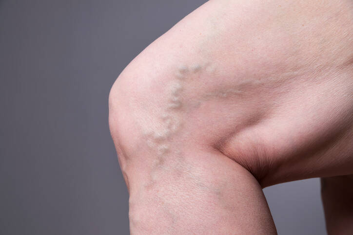 ¿Qué son las varices, las venas varicosas? ¿Por qué surgen, cómo se manifiestan, tienen tratamiento?