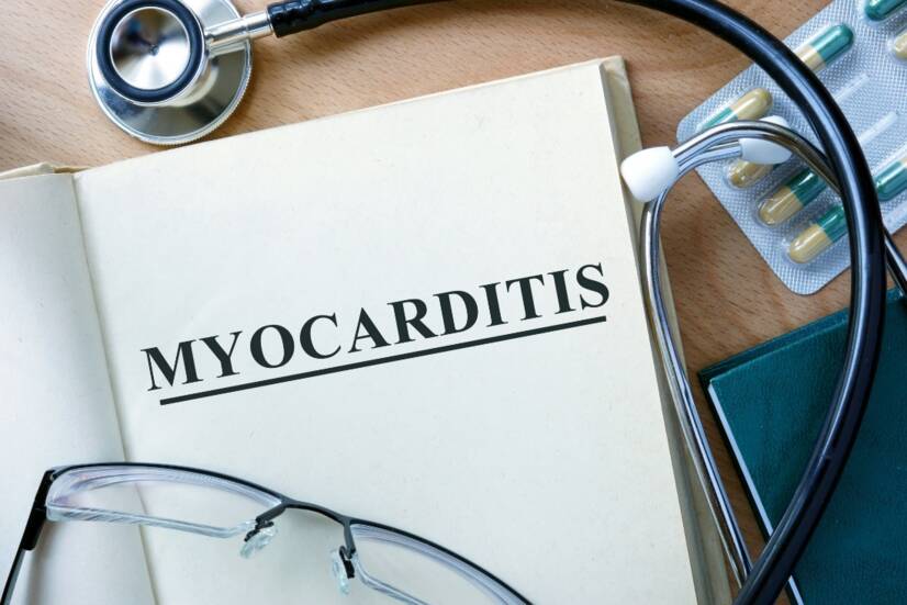 Miocarditis: inflamación del músculo cardíaco. Infarto de miocardio, un tipo de cardiopatía.