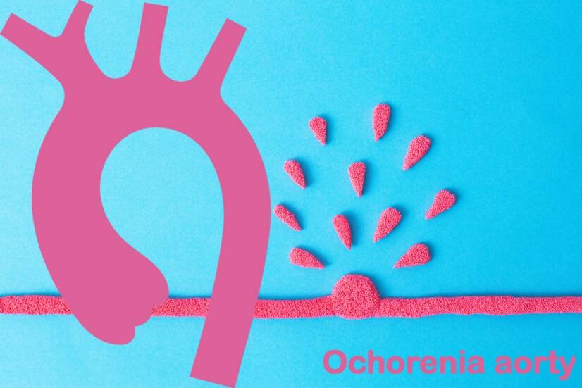 Enfermedad aórtica: ¿aneurisma, disección y otras? Conozca las causas, los síntomas