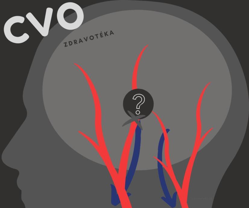 Enfermedad cerebrovascular: ¿vasos sanguíneos cerebrales debilitados, estrechos o dilatados? Conozca las causas y los síntomas