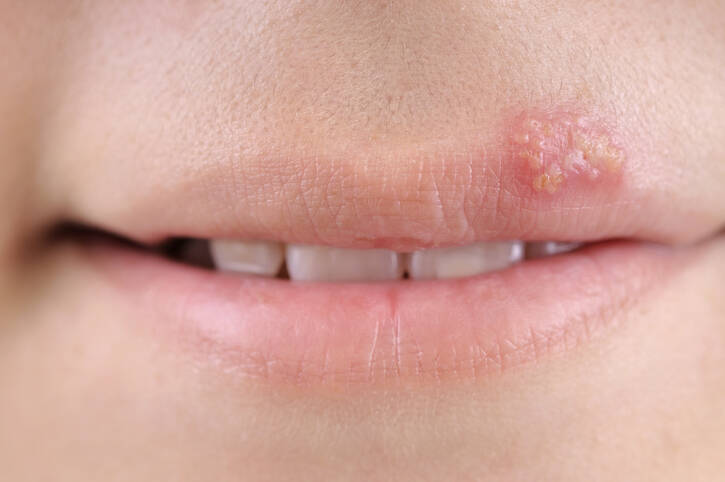 Herpes labial: ¿por qué se produce el herpes y qué ayudará en el tratamiento (qué para el herpes labial)?