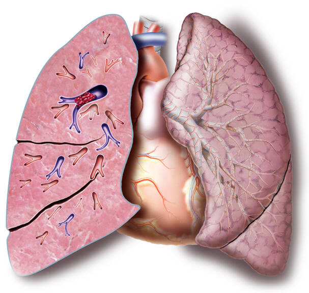 Embolia pulmonar: ¿por qué se produce, cómo se manifiesta, detecta y trata?