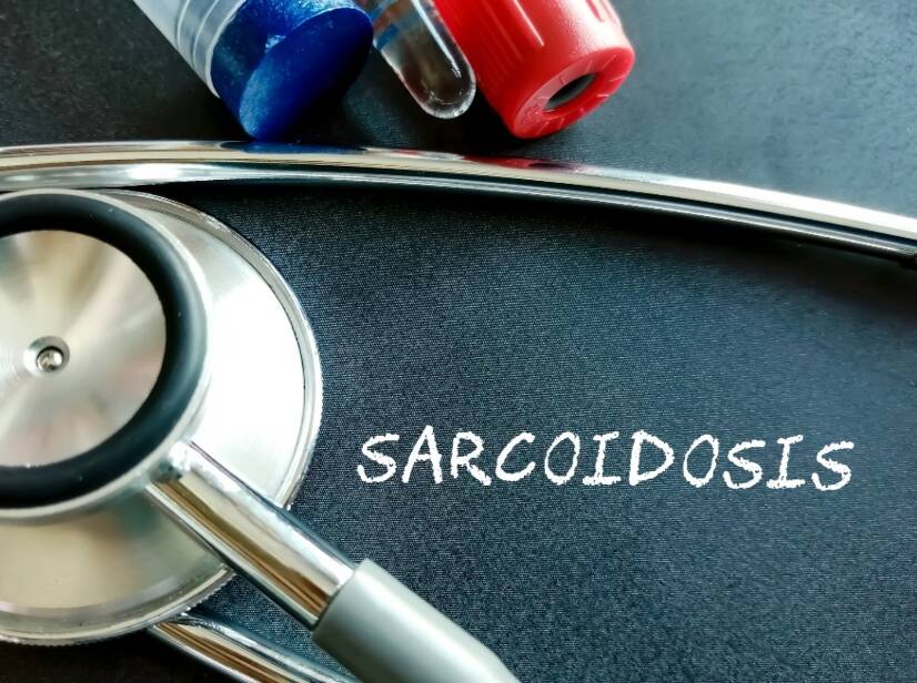 Sarcoidosis: ¿Qué es la sarcoidosis y cuáles son sus causas/síntomas? Formas pulmonares y extrapulmonares