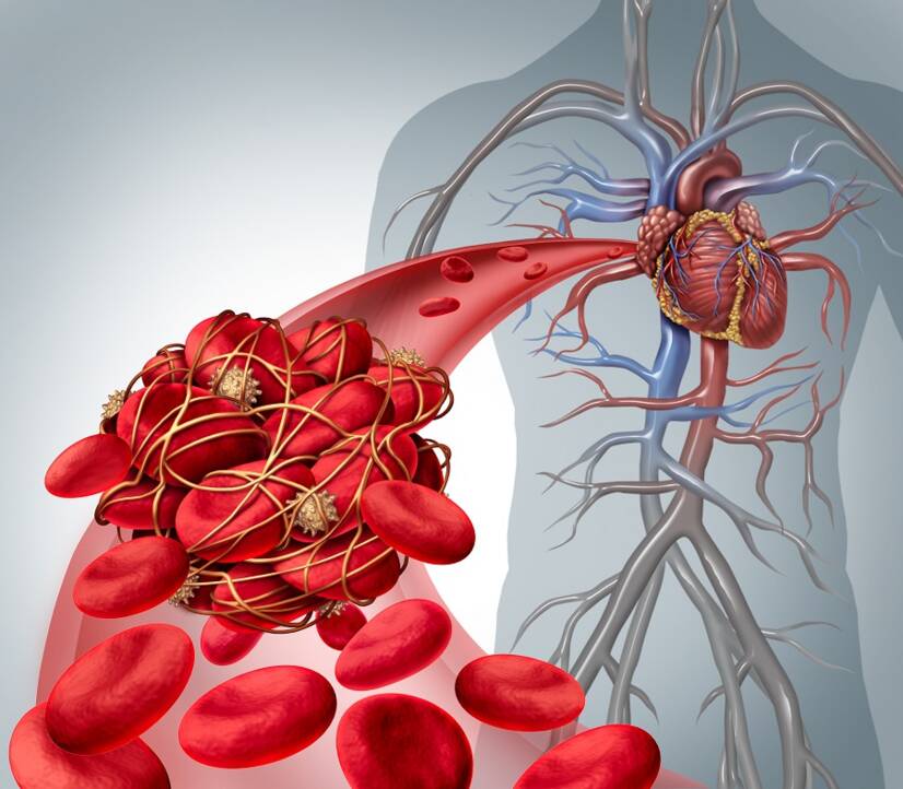 Enfermedad tromboembólica, ¿por qué se produce y qué relación tiene con la embolia pulmonar?