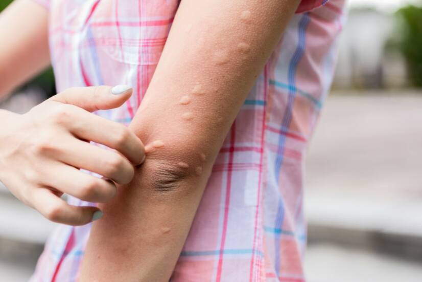 Urticaria: ¿Urticaria no sólo tras una quemadura de ortiga? ¿Significa una enfermedad?