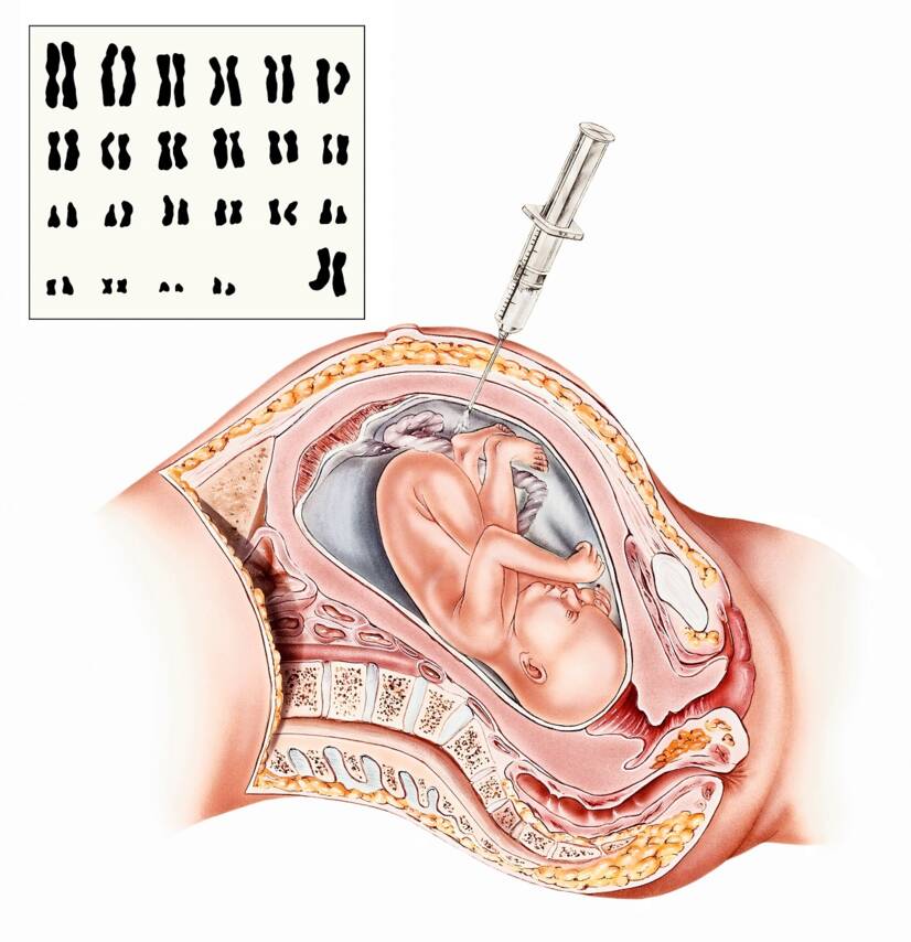 Amniocentesis , fuente: Getty Images