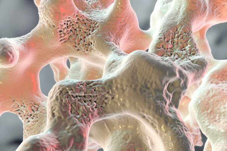 Osteoporosis, osteogénesis infantil ¿Por qué aparece, cómo se manifiesta, se trata?