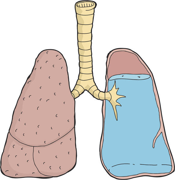 Edema pulmonar: ¿Por qué se produce el edema pulmonar? ¿Es una causa frecuente de muerte?