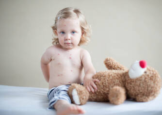 Varicela: ¿Cómo se manifiesta y qué aspecto tiene? En adultos con complicaciones