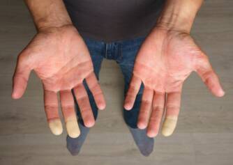 Síndrome de Raynaud: ¿cuál es la causa del entumecimiento de los dedos?