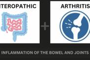 Artritis enteropática y enfermedad inflamatoria intestinal: cómo se relacionan + Síntomas