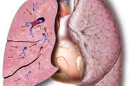 Embolia pulmonar: ¿por qué se produce, cómo se manifiesta, detecta y trata?