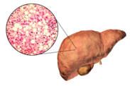 Esteatosis hepática: ¿qué es, por qué se produce y cómo se manifiesta? ¿Cómo tratarla?