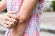 Urticaria: ¿Urticaria no sólo tras una quemadura de ortiga? ¿Significa una enfermedad?